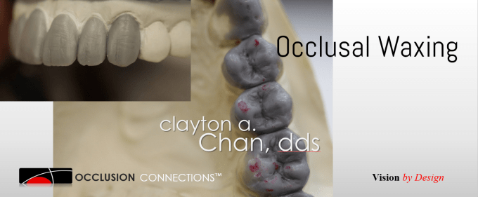 Occlusal Waxing to the GNM Position Occlusion Connections